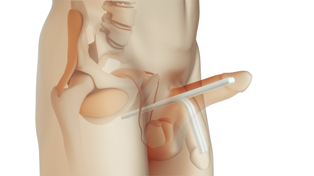 Convalescenza Protesi Peniena - Guida Completa al Recupero Post-Operatorio