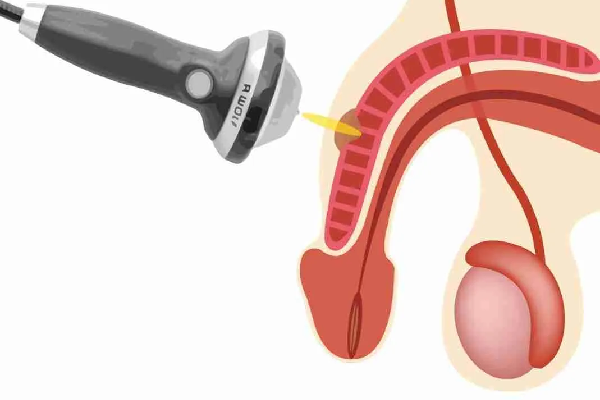 ESWT Onde d'Urto - Terapia Disfunzione Erettile Istanbul €2500 6 Sedute