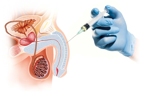 Priapus Shot P-Shot - Terapia PRP per Disfunzione Erettile Istanbul €2300 3 Sedute