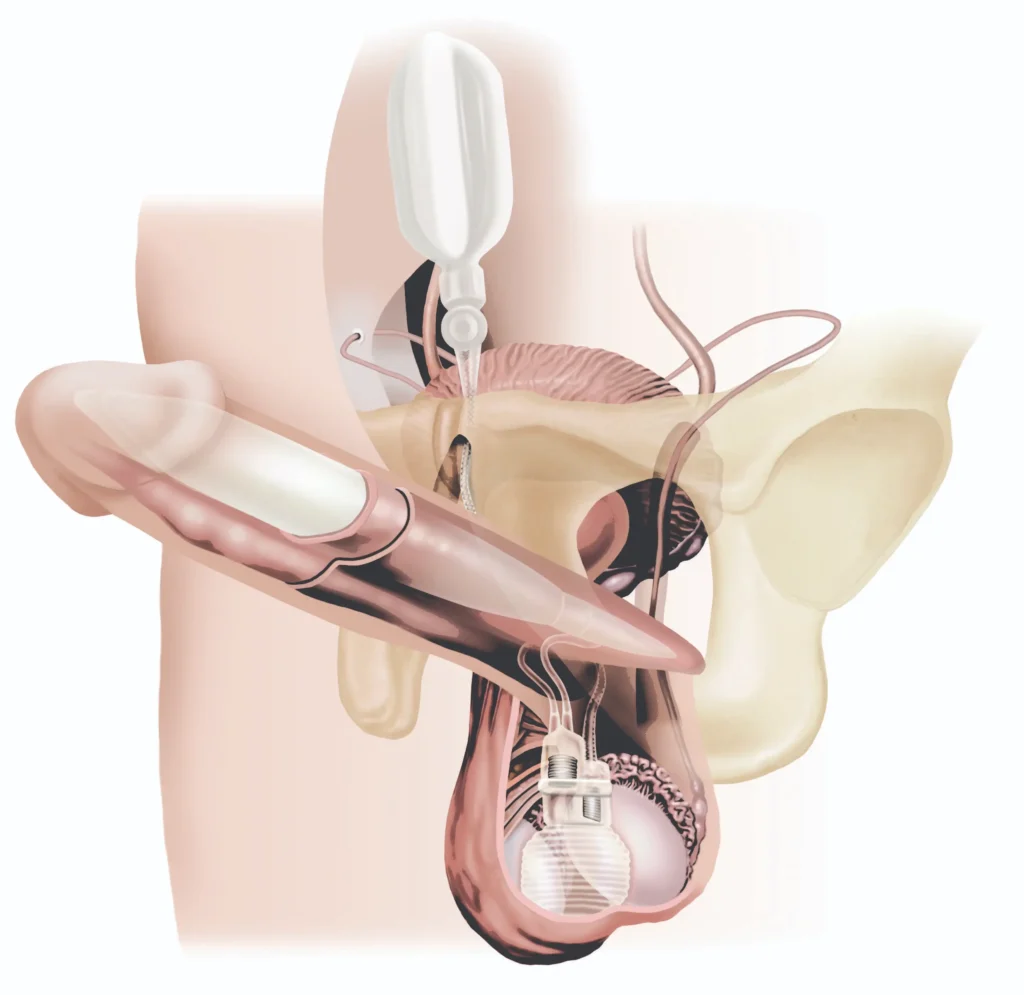 protesi peniena 2026